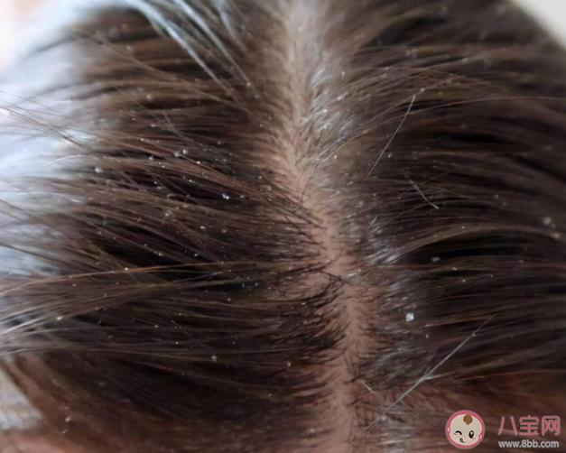 头皮屑增多原因是什么 头皮屑多应该如何清洗 头皮屑增多原因是什么 头皮屑多应该如何清洗