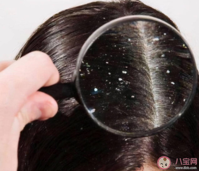 头皮屑增多原因是什么 头皮屑多应该如何清洗 头皮屑增多原因是什么 头皮屑多应该如何清洗