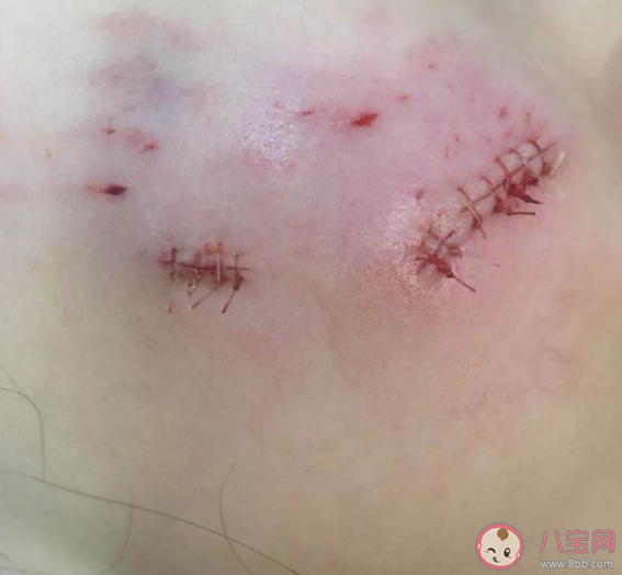 为什么伤口快好的时候比较痒 如何加速伤口愈合