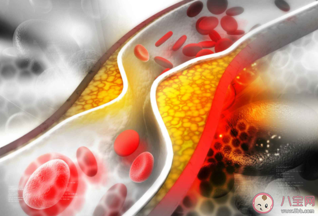 血管能不能软化 这些软化血管的说法都是假的 血管能不能软化 这些软化血管的说法都是假的