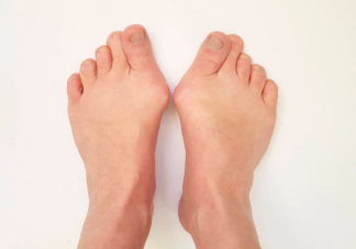 穿高跟鞋会导致拇外翻吗 如何预防拇外翻