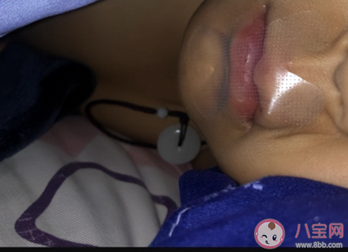 封口贴真有用还是智商税 张嘴呼吸会变丑吗