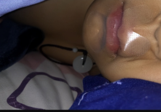 封口贴真有用还是智商税 张嘴呼吸会变丑吗