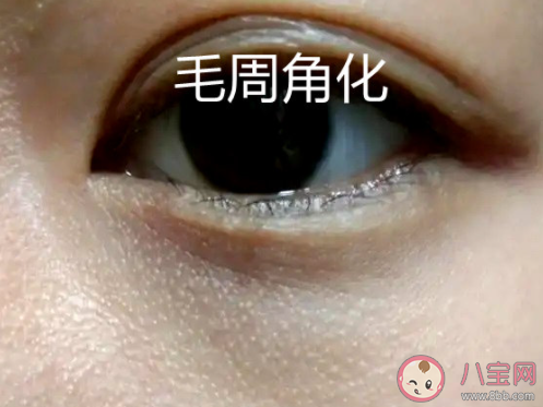 眼下颗粒怎么办 该如何处理眼下颗粒