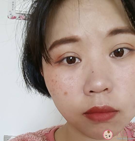 女性脸上雀斑是怎么形成的 雀斑有效检查方法是什么样的