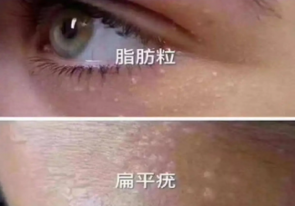 眼下颗粒怎么办 该如何处理眼下颗粒