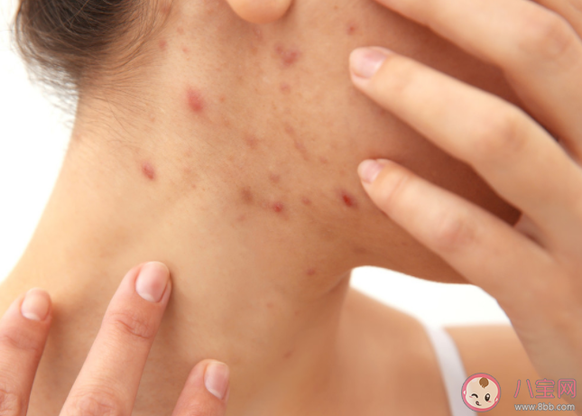 青春痘和青春有关系吗 长青春痘怎么做好得快 青春痘和青春有关系吗 长青春痘怎么做好得快