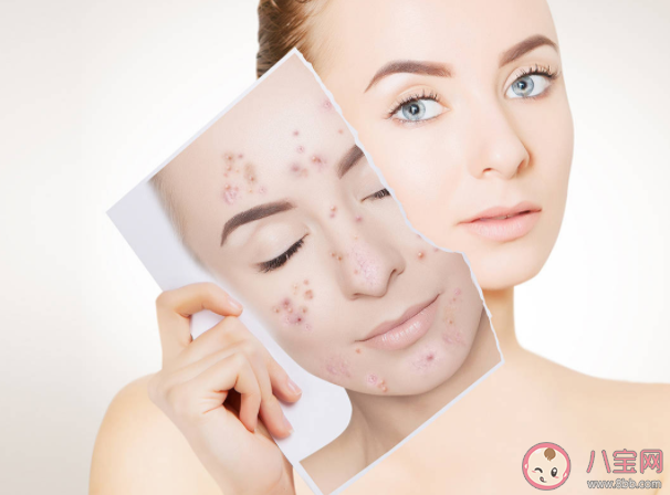 青春痘和青春有关系吗 长青春痘怎么做好得快 青春痘和青春有关系吗 长青春痘怎么做好得快