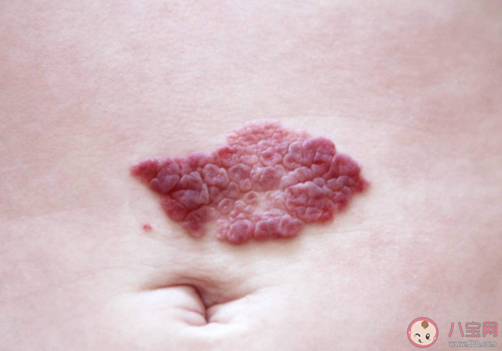 身上胎记会越长越大吗 孩子身上有胎记是因为孕妈没忌嘴吗 身上胎记会越长越大吗 孩子身上有胎记是因为孕妈没忌嘴吗