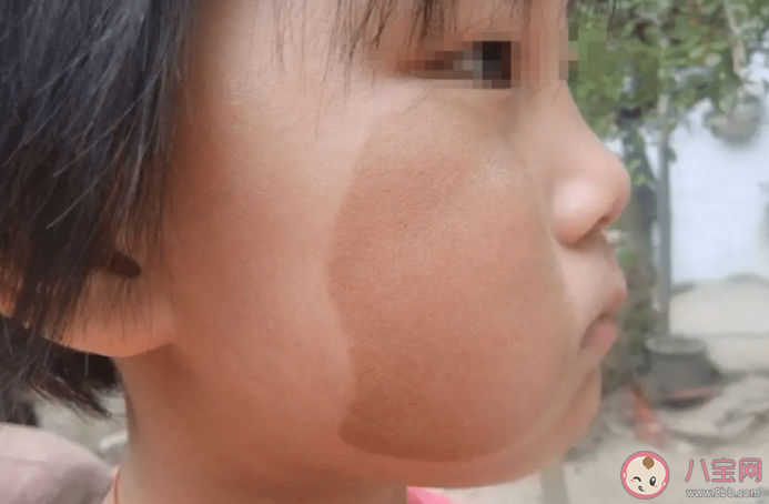 身上胎记会越长越大吗 孩子身上有胎记是因为孕妈没忌嘴吗 身上胎记会越长越大吗 孩子身上有胎记是因为孕妈没忌嘴吗