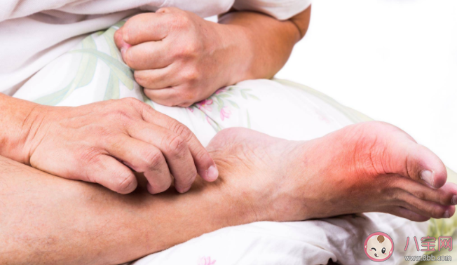 男性更容易痛风吗 痛风是终身疾病吗