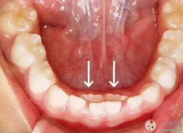 宝宝出现双排牙该怎么办 为什么会长出双排牙