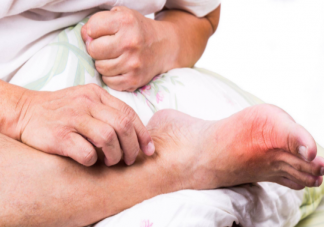 男性更容易痛风吗 痛风是终身疾病吗