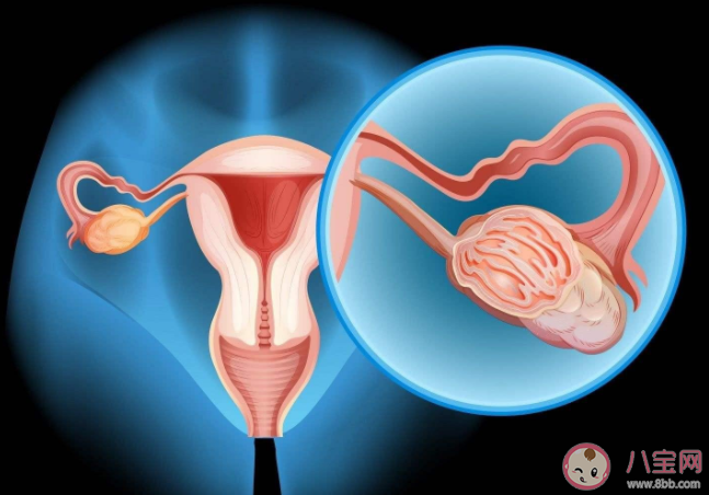 约70%卵巢癌患者确诊已是晚期 为什么卵巢癌难以发现 约70%卵巢癌患者确诊已是晚期 为什么卵巢癌难以发现