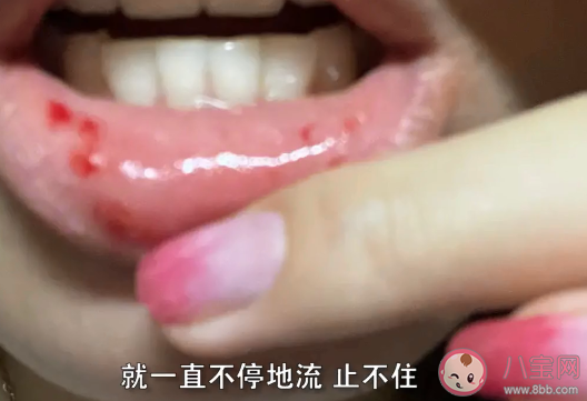女生吃了半个菠萝嘴巴肿胀出血 菠萝要用盐水泡过才能吃吗