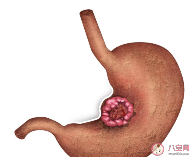 我们的胃到底是怎么坏的 5个方法护胃健康 我们的胃到底是怎么坏的 5个方法护胃健康