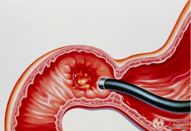 我们的胃到底是怎么坏的 5个方法护胃健康 我们的胃到底是怎么坏的 5个方法护胃健康