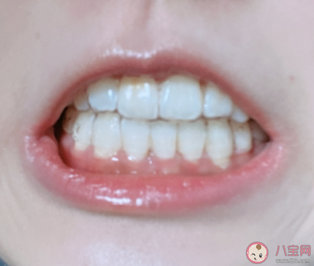 箍牙会导致牙齿松动吗 箍牙的步骤流程是怎样的 箍牙会导致牙齿松动吗 箍牙的步骤流程是怎样的