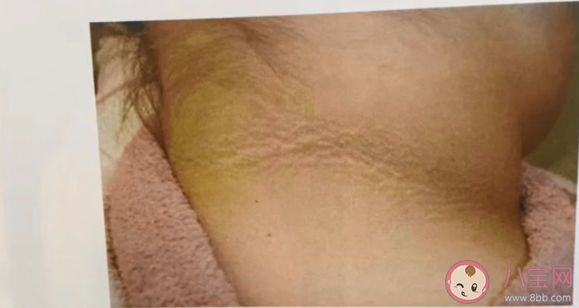 为何有些肥胖人士脖子老是洗不干净 黑棘皮病严重吗危害大不大