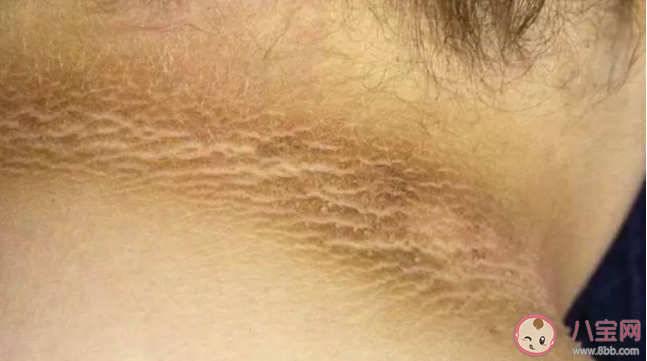 为何有些肥胖人士脖子老是洗不干净 黑棘皮病严重吗危害大不大