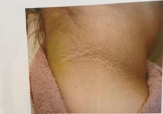 为何有些肥胖人士脖子老是洗不干净 黑棘皮病严重吗危害大不大