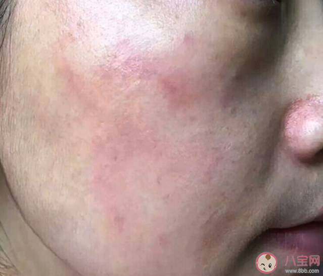 过敏和皮肤敏感如何区分 皮肤敏感和过敏有什么区别