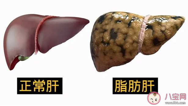 蚂蚁庄园5月25日答案：体检查出脂肪肝还能继续吃肉吗