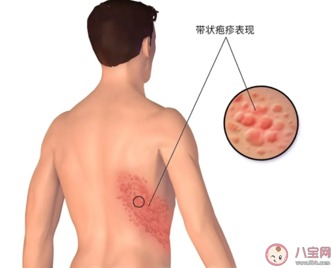 带状疱疹为什么那么痛 带状疱疹如何做好预防 带状疱疹为什么那么痛 带状疱疹如何做好预防