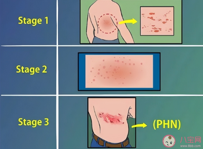 带状疱疹为什么那么痛 带状疱疹如何做好预防 带状疱疹为什么那么痛 带状疱疹如何做好预防