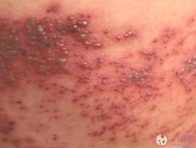 为什么带状疱疹好了还会疼 哪些人是带状疱疹高发人群 为什么带状疱疹好了还会疼 哪些人是带状疱疹高发人群