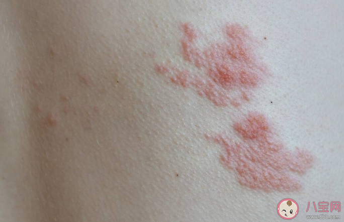 水痘和带状疱疹有什么区别 没得过水痘会得带状疱疹吗 水痘和带状疱疹有什么区别 没得过水痘会得带状疱疹吗