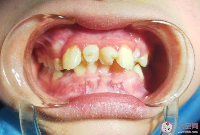 多生牙是什么意思有什么危害 多生牙需要拔除吗