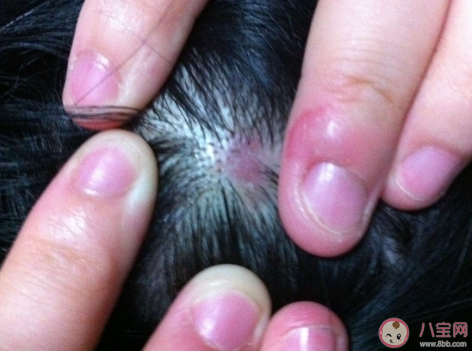 头皮上的痂是什么 为何头皮上总是长疙瘩和脓包 头皮上的痂是什么 为何头皮上总是长疙瘩和脓包