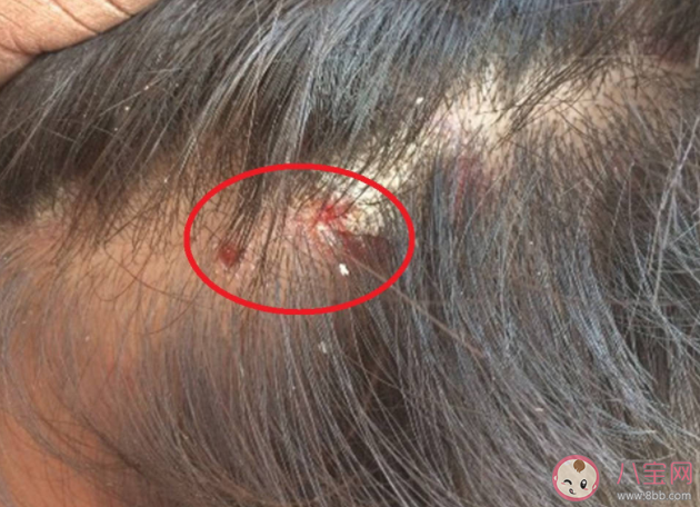 头皮上的痂是什么 为何头皮上总是长疙瘩和脓包 头皮上的痂是什么 为何头皮上总是长疙瘩和脓包