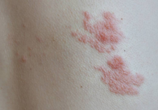 水痘和带状疱疹有什么区别 没得过水痘会得带状疱疹吗