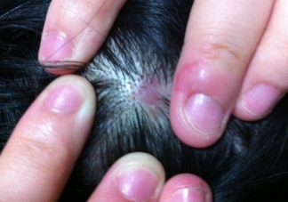 头皮上的痂是什么 为何头皮上总是长疙瘩和脓包