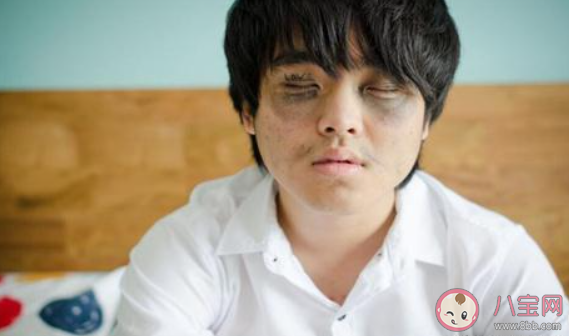 为什么不熬夜也会有黑眼圈 该如何消除黑眼圈