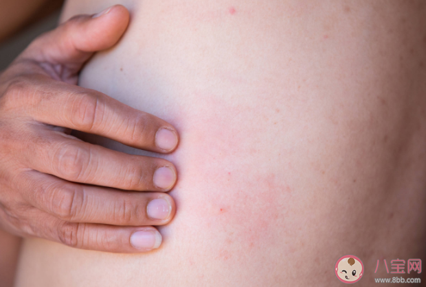 带状疱疹能自愈为什么要预防 带状疱疹疫苗为什么50岁以上才能接种