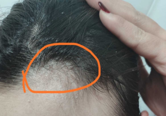 反复头屑的原因是什么 头屑过多如何洗头用药