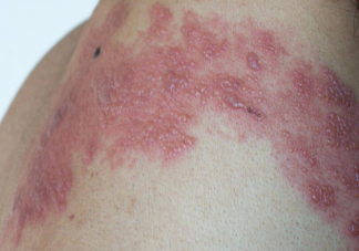 带状疱疹能自愈为什么要预防 带状疱疹疫苗为什么50岁以上才能接种