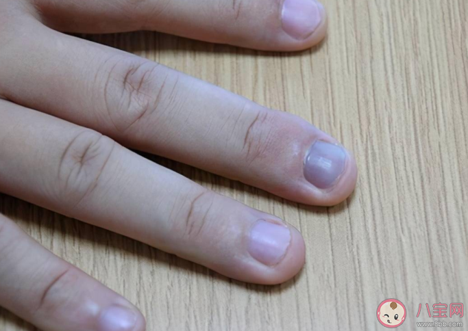 灰指甲可以不治吗 灰指甲拔了才能彻底治好吗
