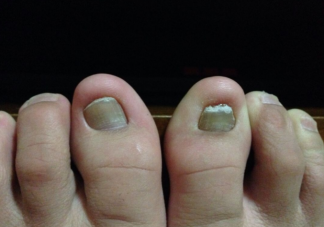 灰指甲可以不治吗 灰指甲拔了才能彻底治好吗