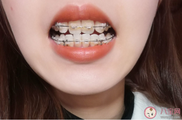 成年人矫正牙齿更容易反弹吗 矫正牙齿有年龄限制吗