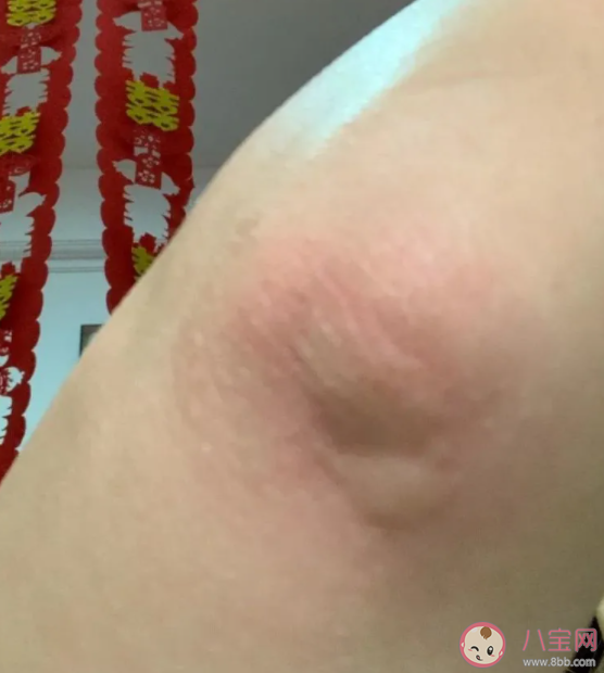 蚊子包越大毒性越大吗 被蚊子咬起大包怎么办 蚊子包越大毒性越大吗 被蚊子咬起大包怎么办