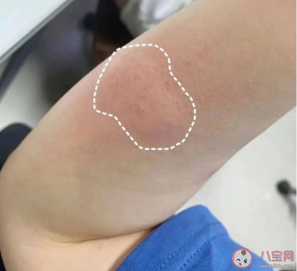 蚊子包越大毒性越大吗 被蚊子咬起大包怎么办 蚊子包越大毒性越大吗 被蚊子咬起大包怎么办