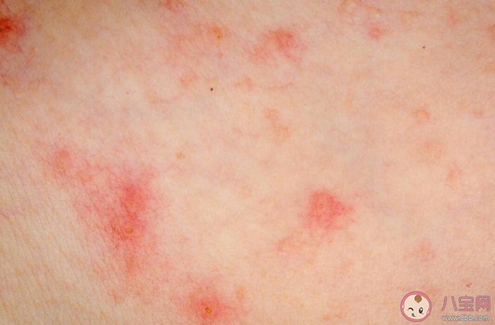 涂花椒水可治过敏性皮炎吗 如何预防过敏性皮炎