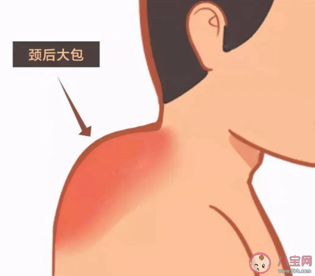 如何判断自己是否有富贵包 富贵包康复训练怎么做