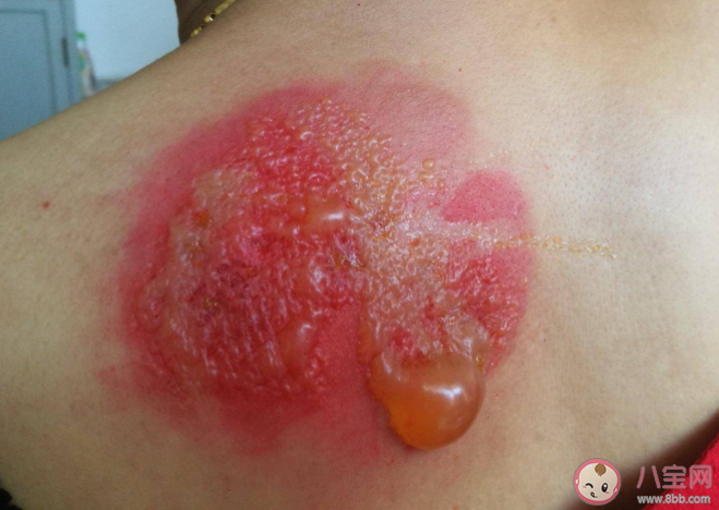 隐翅虫毒液堪比硫酸 隐翅虫咬人致命吗