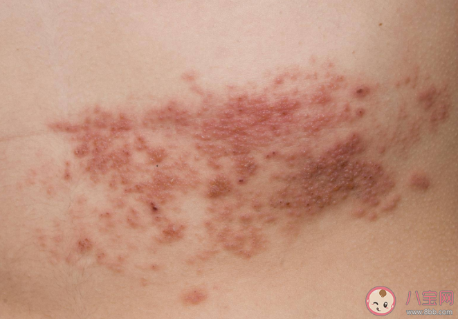 哪些人易感染带状疱疹 如何日常生活中预防带状疱疹