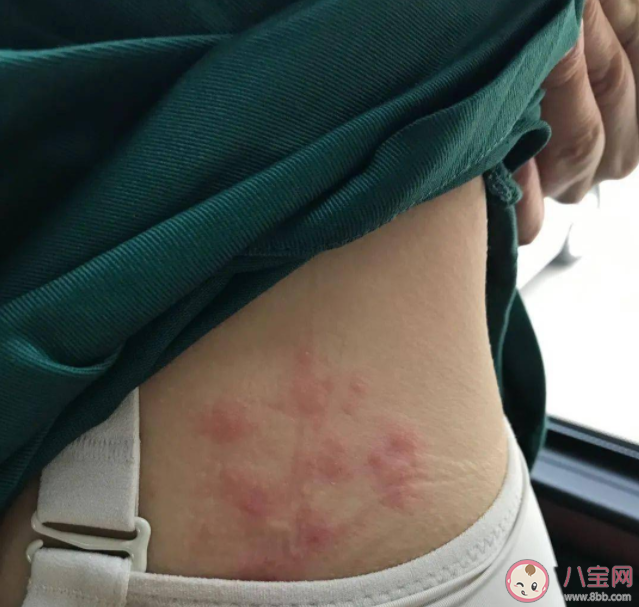 带状疱疹长满一圈会死人吗 带状疱疹会致命吗